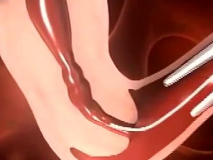 泰国第三代试管婴儿真的痛苦吗？